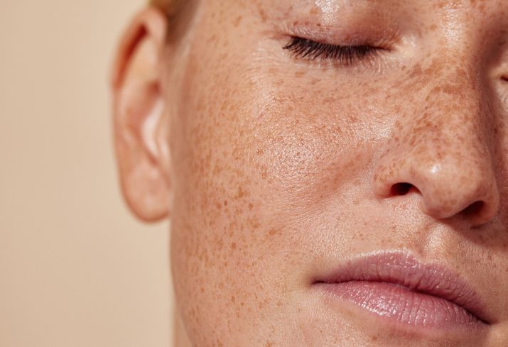 Is Dermal Pigmentation Therapy Safe For The Skin? by dynamicaesthetic