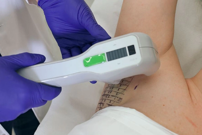 What Areas Are Suitable For Miradry Treatment Application? by Ahmad Hassan