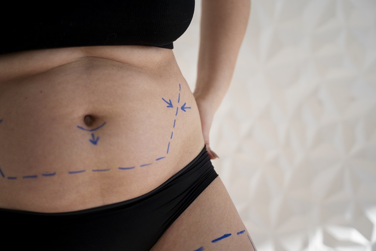 What To Avoid Before And After Tummy Tuck Surgery In Riyadh by momin7