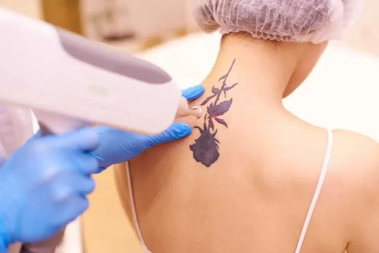 How Effective Is Picosure Tattoo Removal For All Ink Types? by fatimadynamic