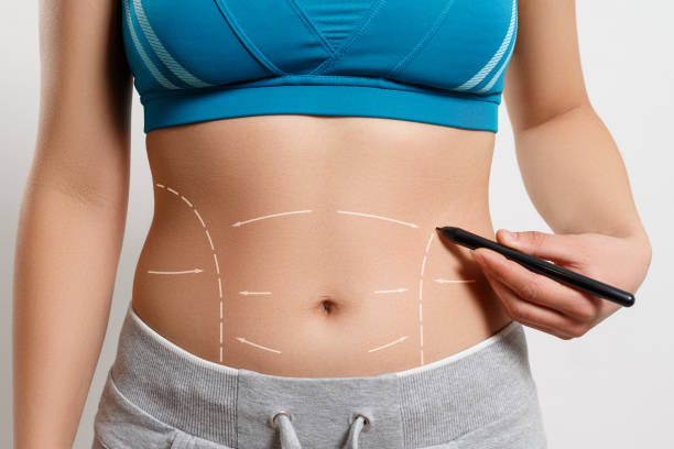 What Areas Can Liposuction Target? by Enfieldabudhabi