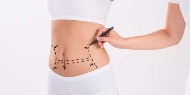 How Soon Can You Exercise After Pubic Lift Surgery? by Dynamicclinic12