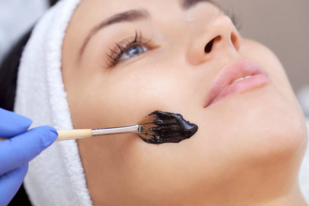 Chemical Peels In Riyadh: Top Questions Answered By Experts by momin7