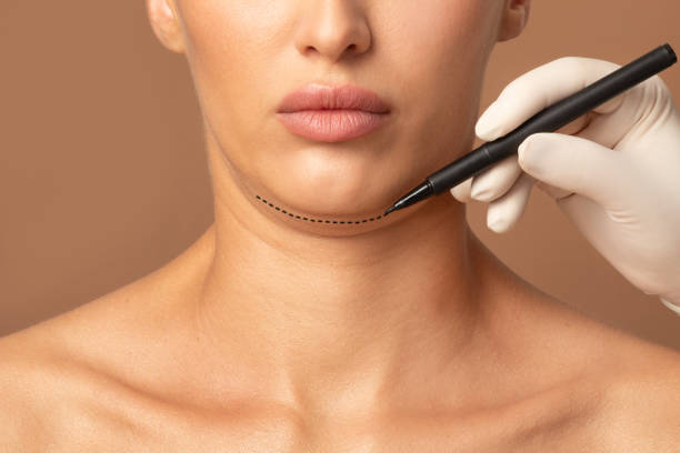 How Chin Liposuction Improves Your Side Profile ? by Enfieldabudhabi