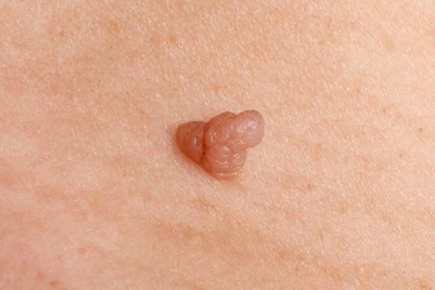 Does Warts Removal Leave Scars On The Skin? by Enfieldabudhabi
