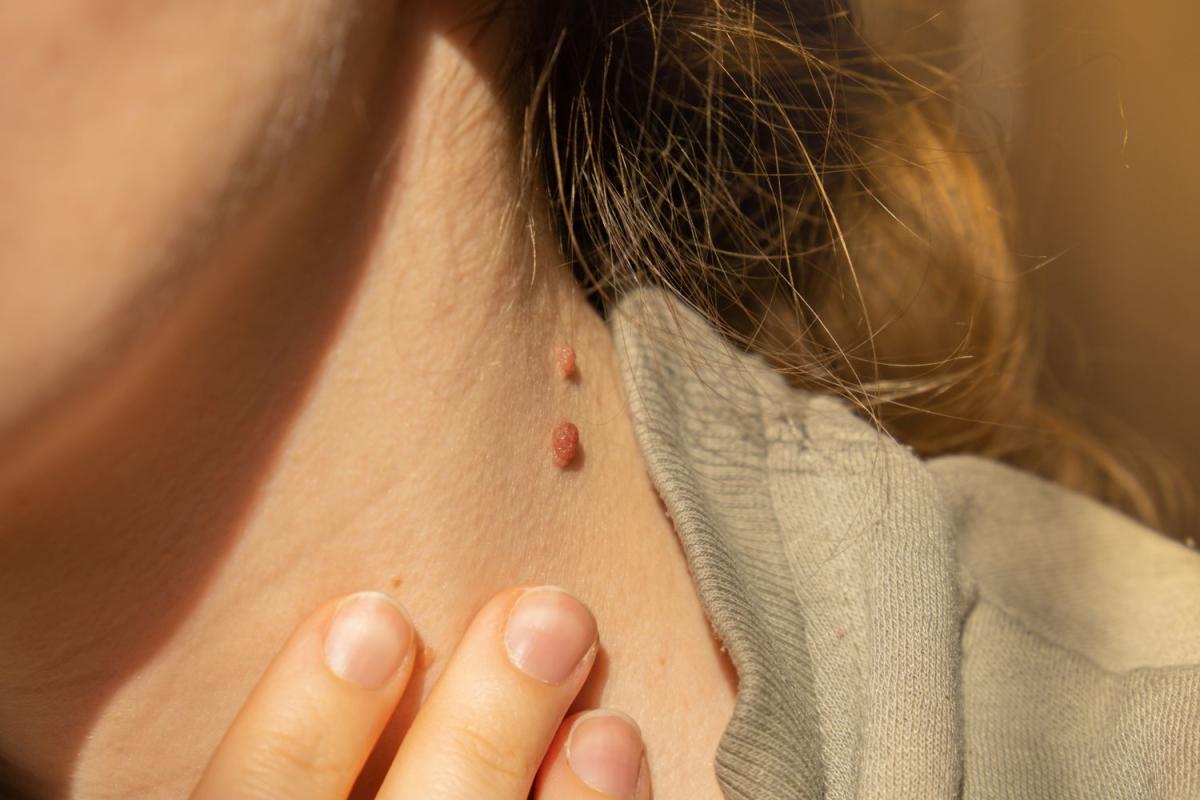 What Age Is Best For Birthmark Removal? What Age Is Best For Birthmark Removal? by dynamicclinic