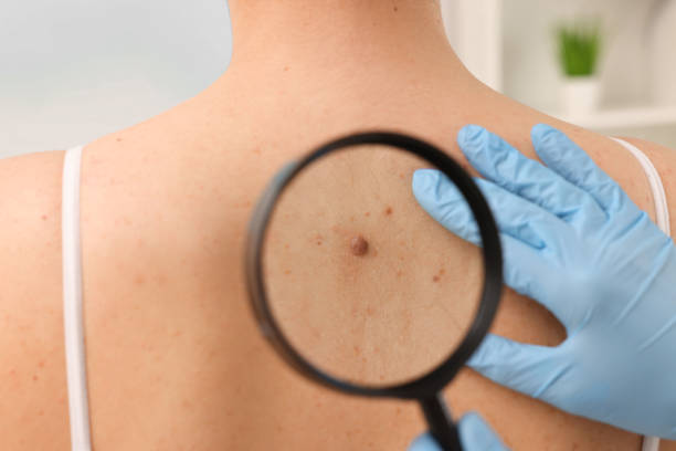 Skin Tag Removal: Common Questions Answered by mominenfield