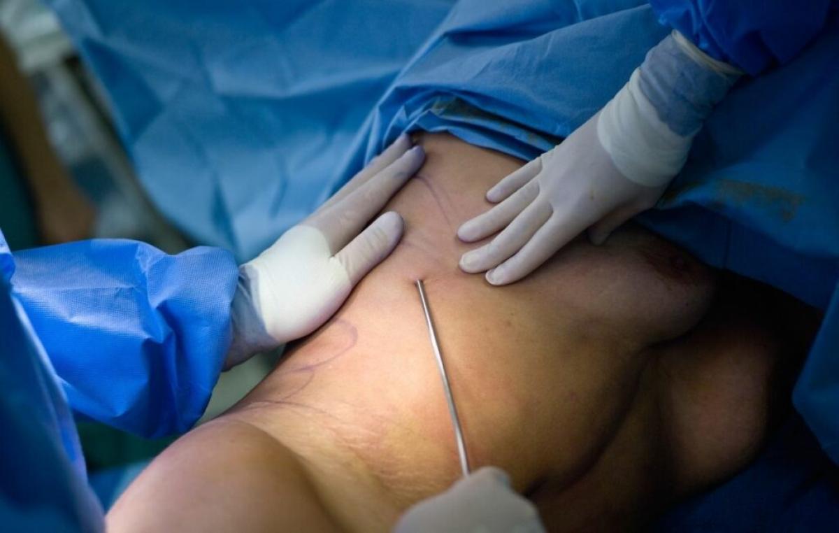 Who Is An Ideal Candidate For Liposuction? by fatimadynamic