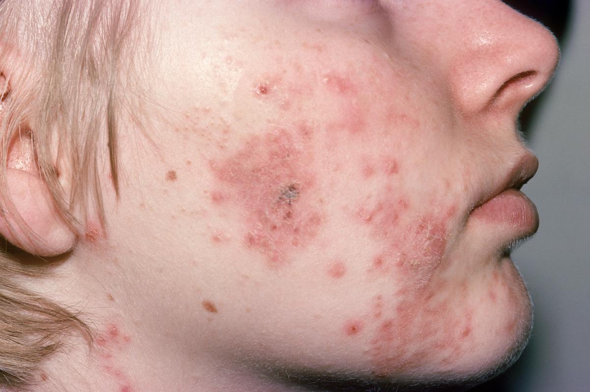How Does Hormonal Imbalance Cause Pimples? by fatimadynamic
