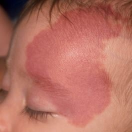 Is Port Wine Stain Treatment Safe For Children At A Young Age? by dynamicaesthetic