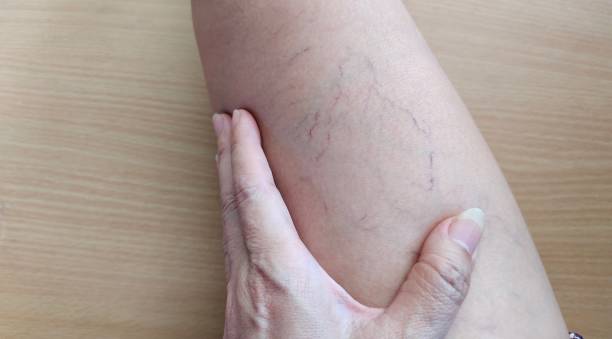 Comprehensive Look At Varicose Vein Treatment by mominenfield