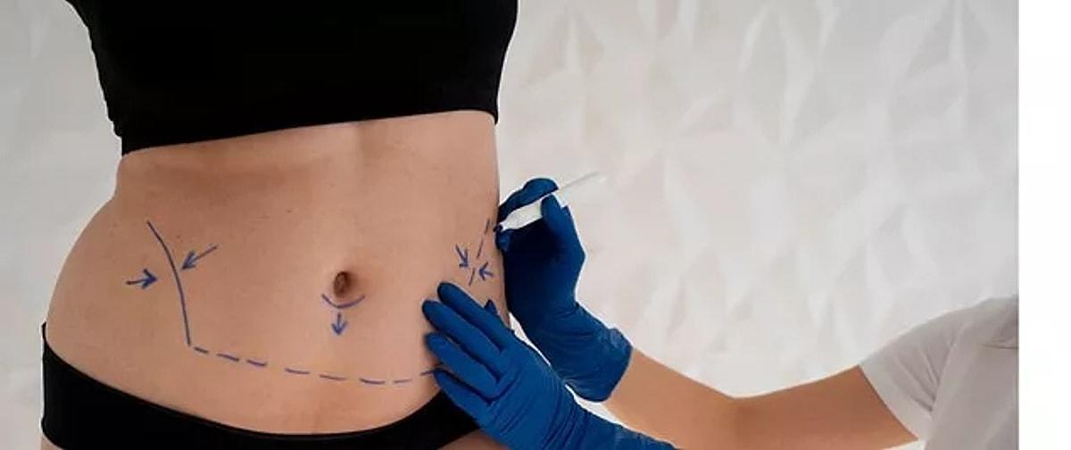 Can A Tummy Tuck Be Reversed Or Revised Later? by Dynamicclinic12