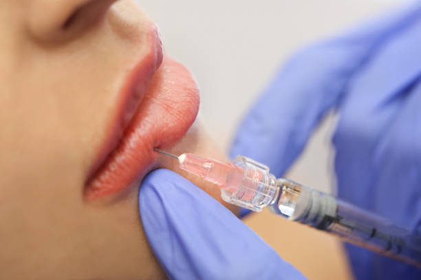 Are Lip Fillers Suitable For Thin Or Aging Lips? by Enfieldabudhabi