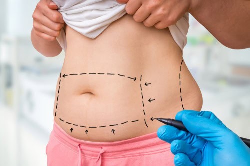 What Are The Benefits Of Tummy Tuck Surgery? by dynamicaesthetic