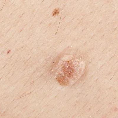 What Are The Common Ways To Remove A Skin Tag? by dynamicaesthetic