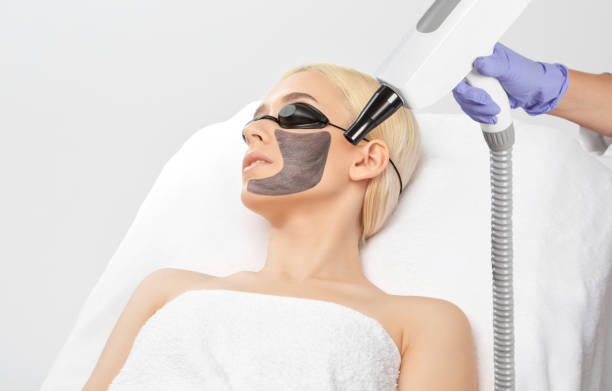 Can Laser Carbon Peel Help Fade Pigmentation? by Enfieldabudhabi