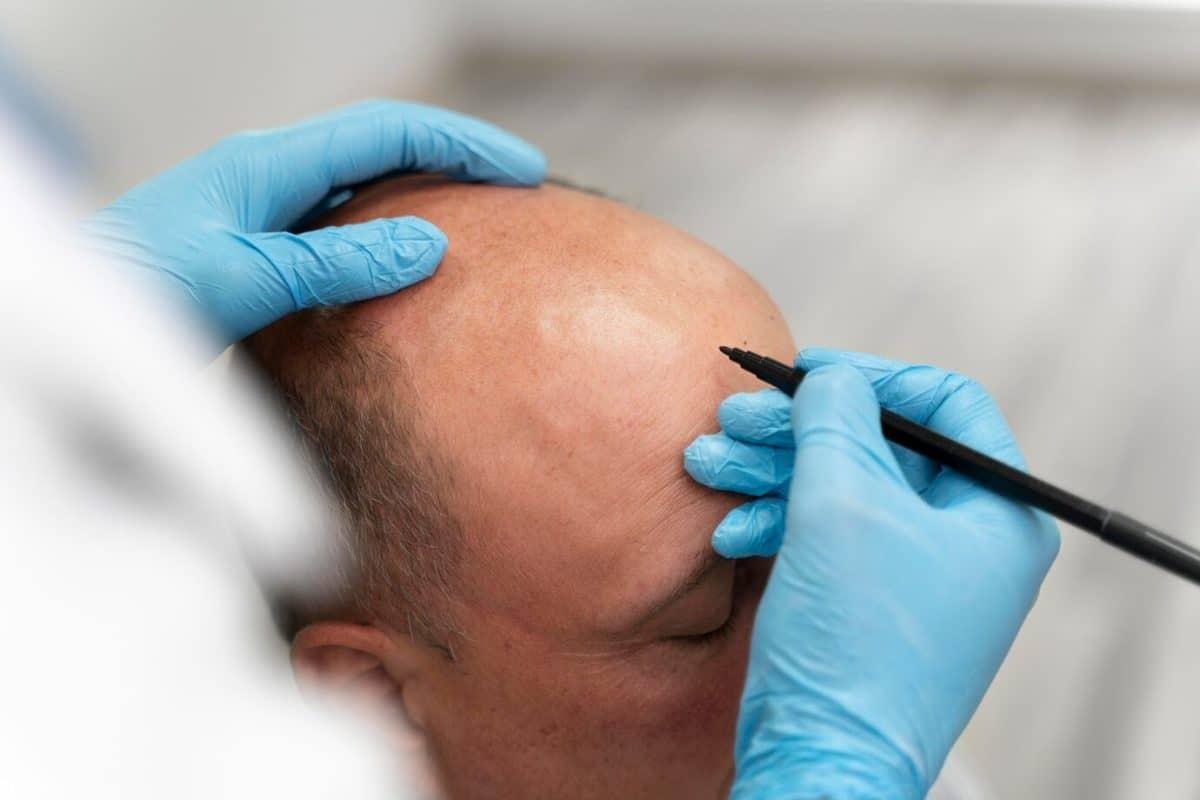 What Are The Common Myths About Hair Transplant? What Are The Common Myths About Hair Transplant? by eirhakhan