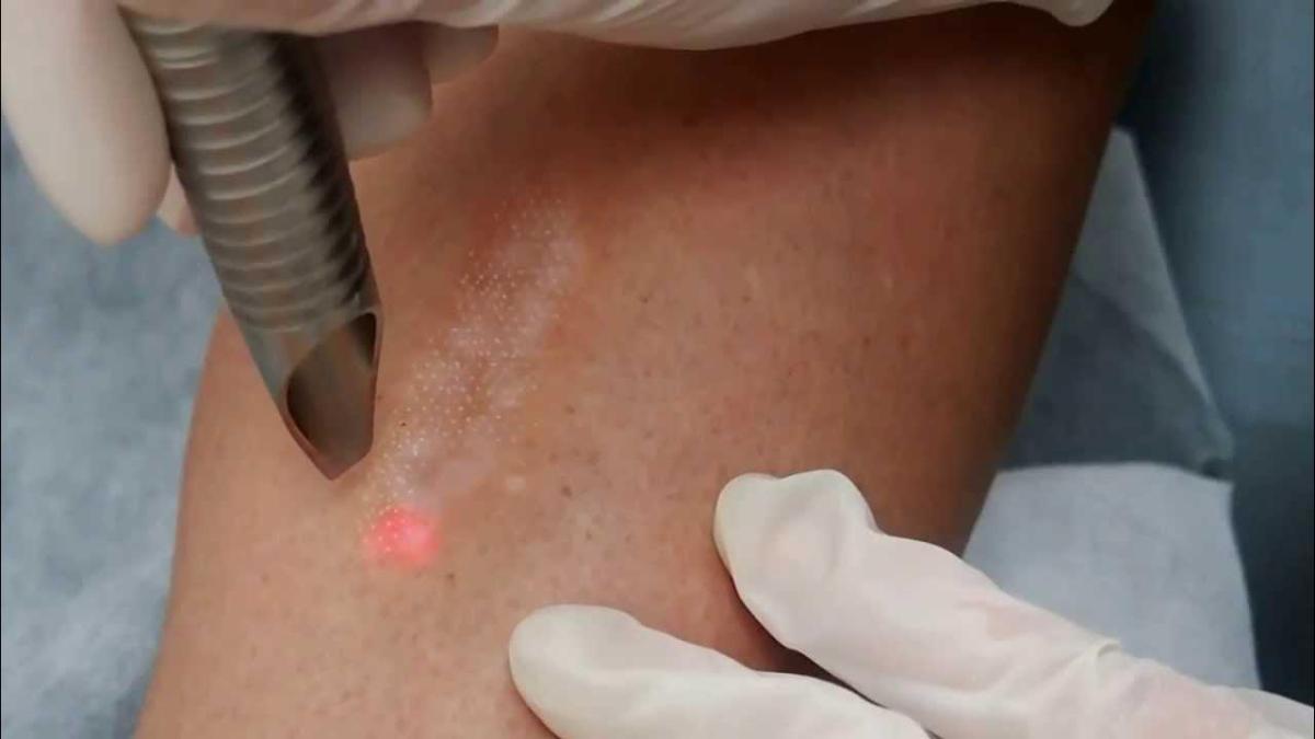 Does Laser Therapy Improve Scar Texture And Color? by cdynmic