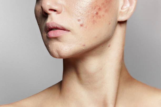 Can Enfield Royal Clinic Treat Acne And Acne Scars Effectively? by Enfieldabudhabi