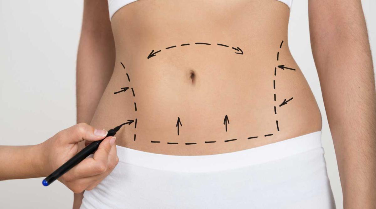 How Do You Decide Which Tummy Tuck Technique Is Best? by dynamicaesthetic