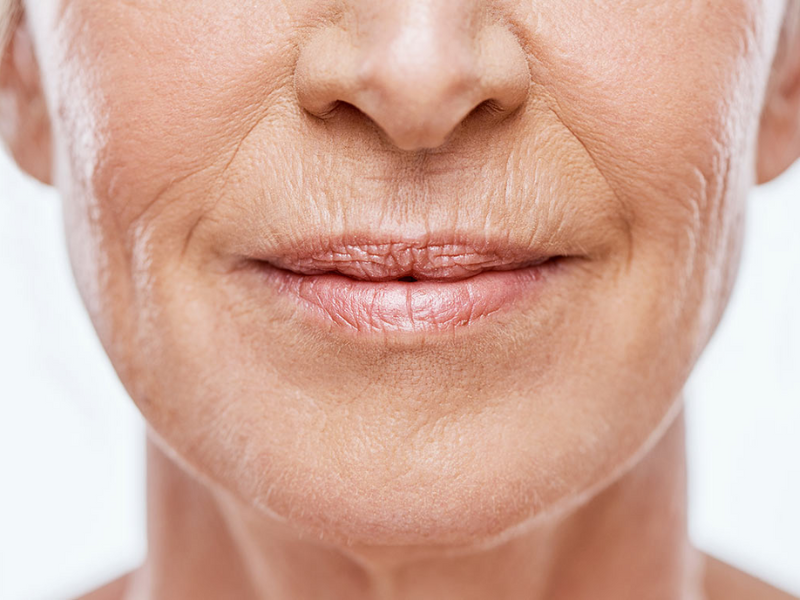 Can Wrinkle Treatments Reduce Lines Around The Mouth Area? by dynamicaesthetic