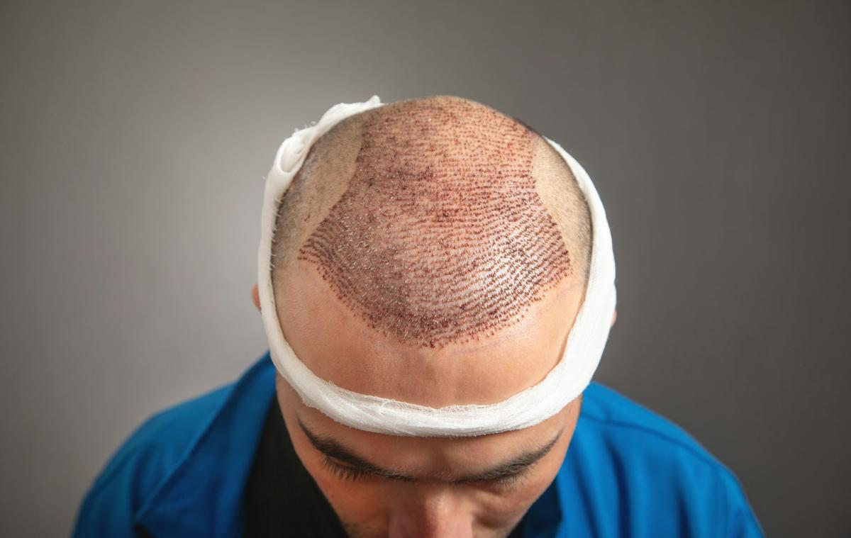 Can Hair Transplant Be Performed On Curly Hair Safely Now? by aestheticclinicdubai6@gmail.com