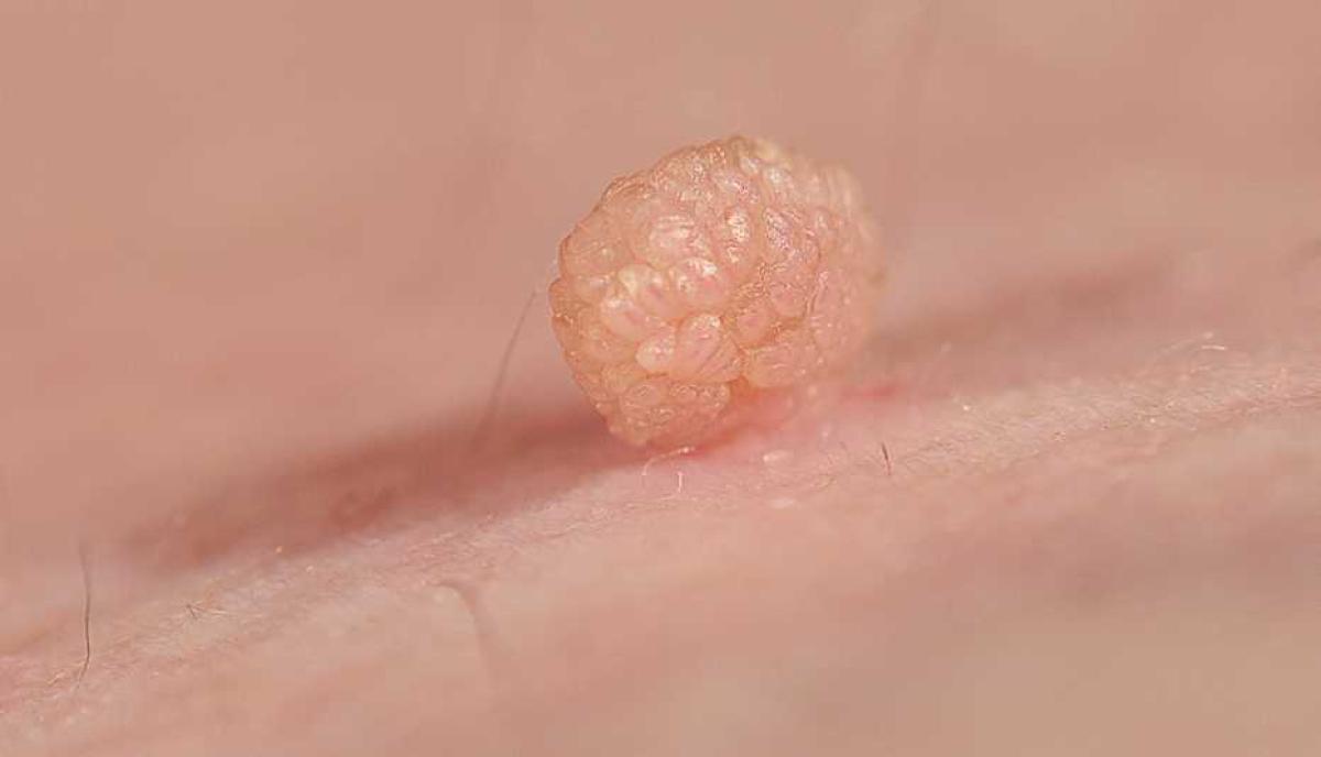 Do You Need More Than One Session To Fully Remove A Skin Tag? by dynamicaesthetic