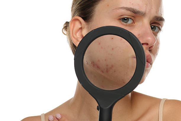 Laser Acne Treatment For Oily Skin Solutions by mominenfield