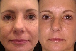 Restore Skin Vitality Instantly With Plasma Pen Treatment by pookie46