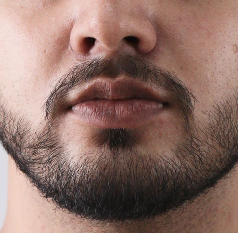 What Age Group Benefits Most From Smoker’s Lips Treatment? by dynamicaesthetic