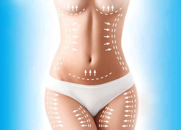 How Long Do Results Of Laser Liposuction Last? by Enfieldabudhabi