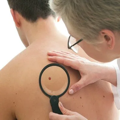 Is Dermoscopy Mole Evaluation Safe? by dynamicaesthetic