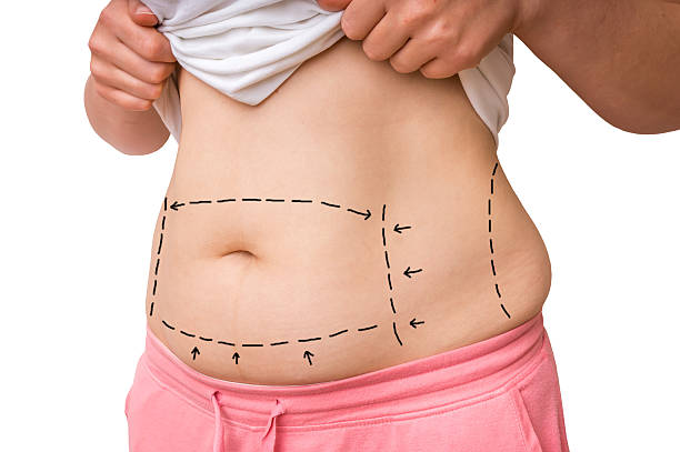 Understanding The Role Of Lipo Abdominoplasty In Body Shaping In Riyadh by enfieldroyalsaudi050