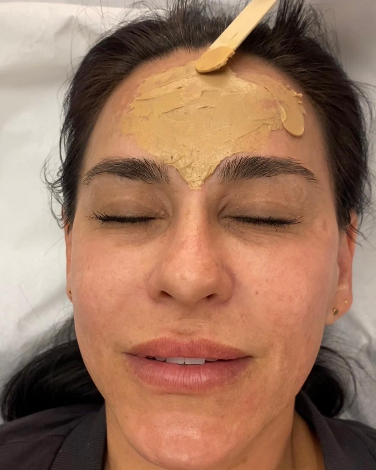 Can Cosmelan Peel Treatment Keep Skin Clear And Spot-Free? by dynamiclifeclinics