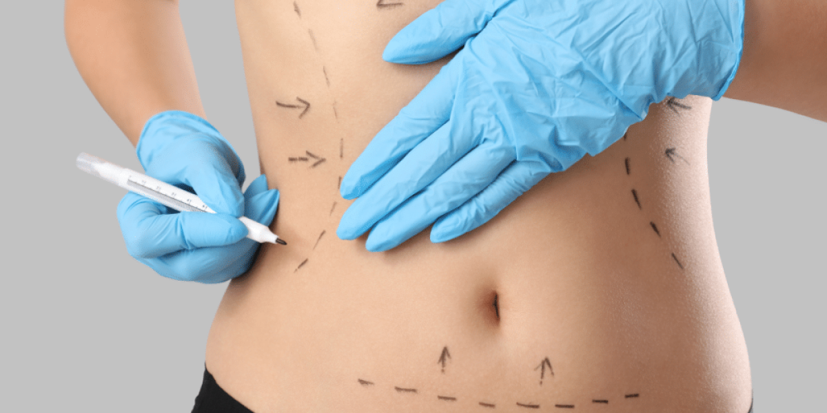 Does Tummy Tuck Silicon Oasis Remove Loose Skin? by Ahmad Hassan