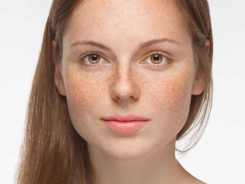 Can Pigmentation Treatment Help Correct Uneven Skin Tone? by dynamicaesthetic