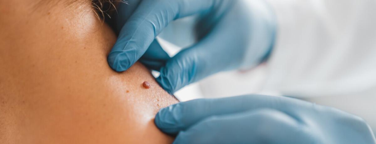 Want Moles Removal For A Smooth Glow? by Dynamicclinic12