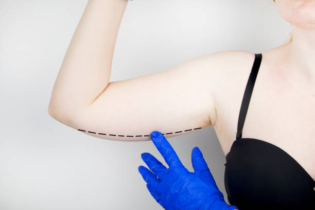 Arm Lift Surgery Recovery Tips For Faster Healing And Better Results by enfieldroyalsaudi050