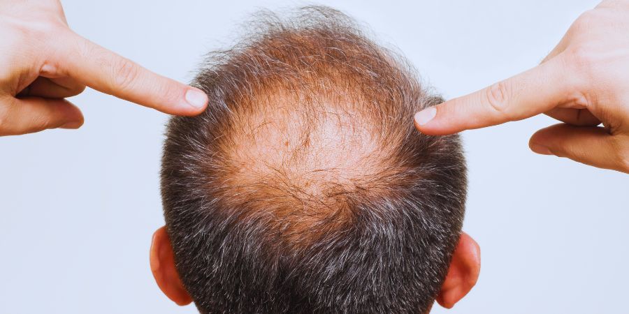 What Is A Crown Hair Transplant And How Does It Work? by fatimadynamic