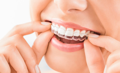 What Parents Need To Know About Invisalign What Parents Need To Know About Invisalign by pdgdentalca