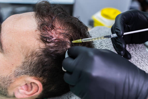 PRP Hair Treatment In Riyadh: Top Questions Answered by momin7