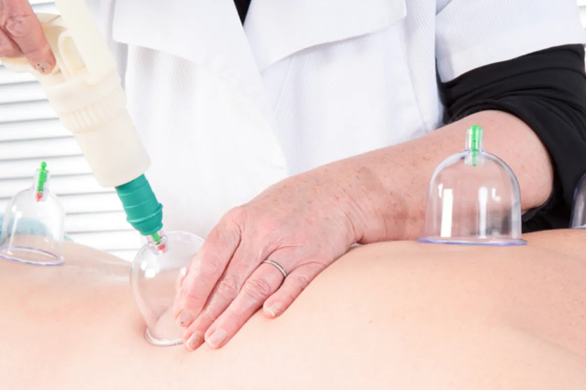 Unlock Healing Potential With Hijama Cupping Therapy Techniques by pookie46