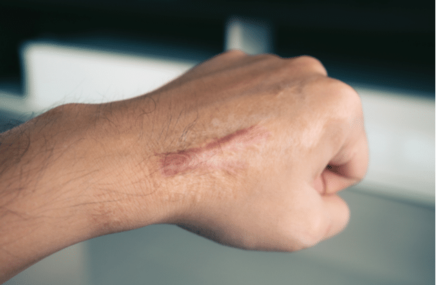 Can Laser Therapy Help Reduce The Appearance Of Hypertrophic Scars? by cdynmic