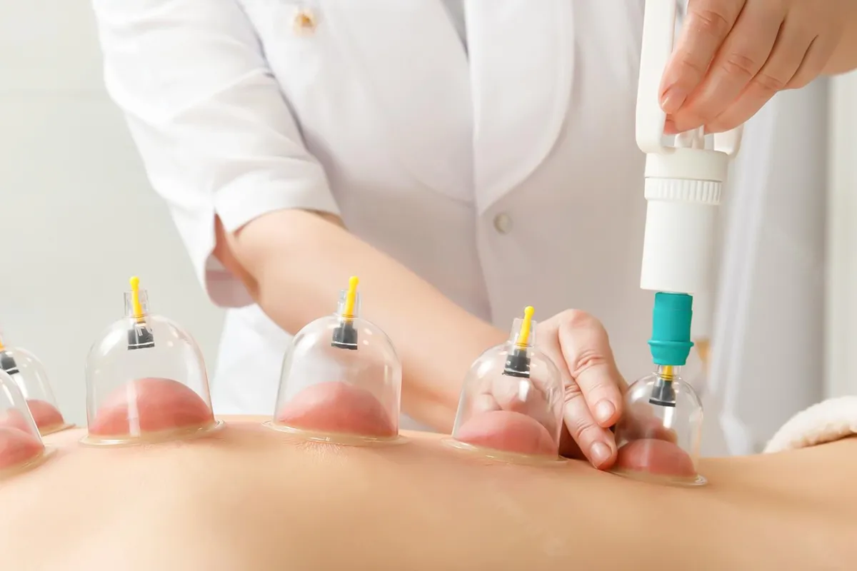 Experience Renewed Strength And Balance With Hijama Cupping Therapy by pookie46