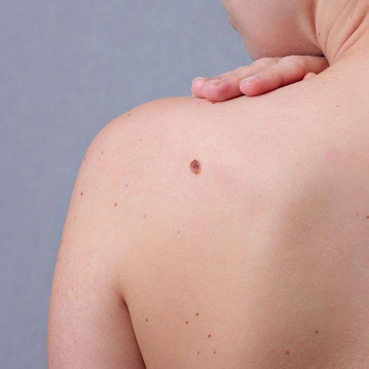 How Long Does Warts Removal Usually Take? How Long Does Warts Removal Usually Take? by MuhammadAhmad