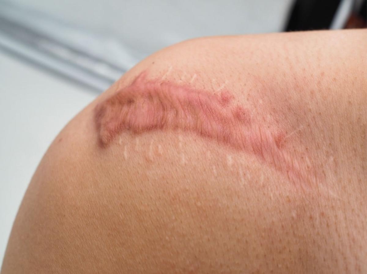 Does Post-Surgical Scar Treatment Prevent Raised Scars? by Taimoor Tahir