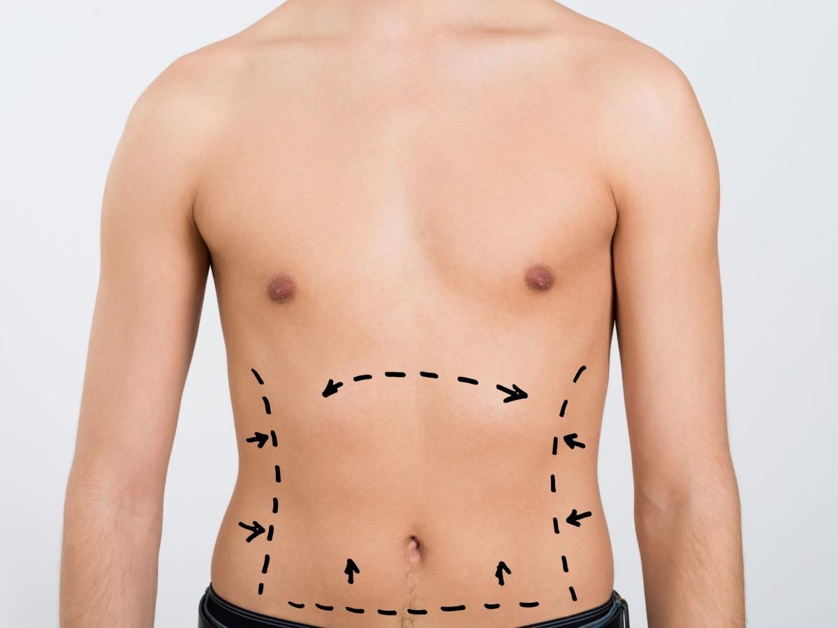 What Is Vaser 4D Liposuction? by Dynamicclinic12