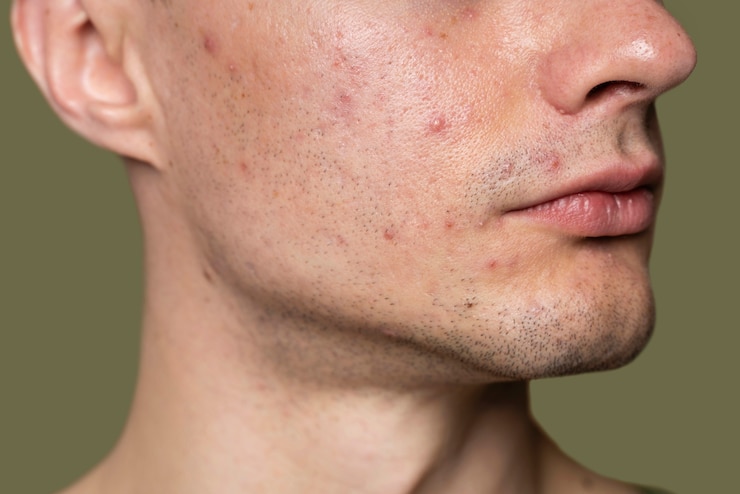 Can The Best Pimples Treatment Control Oily Skin Effectively? by Dynamic Life Clinics