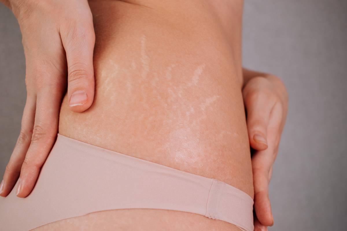 How Does Dermabrasion Work For Stretch Marks Removal? by Bisma jamal