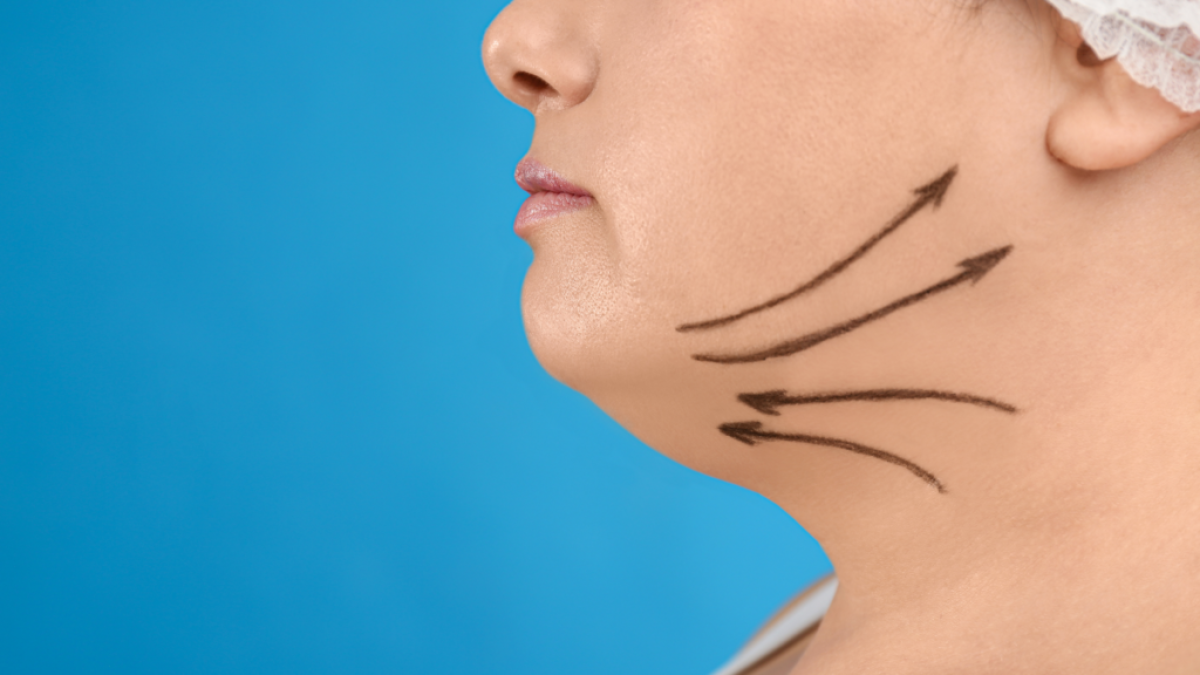 How Does Chin Liposuction Work? by Dynamicclinic12
